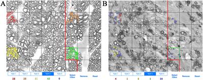 Systems Genetics of Optic Nerve Axon Necrosis During Glaucoma